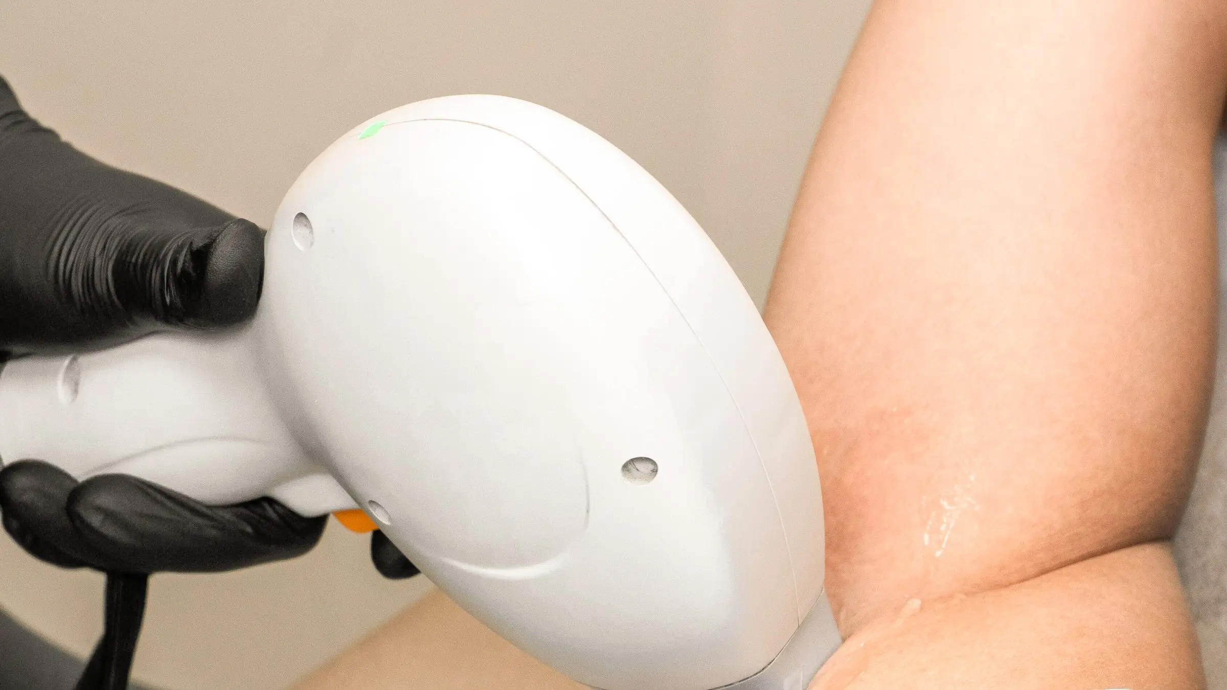 Permanent hårfjerning med diodelaser i armhulen