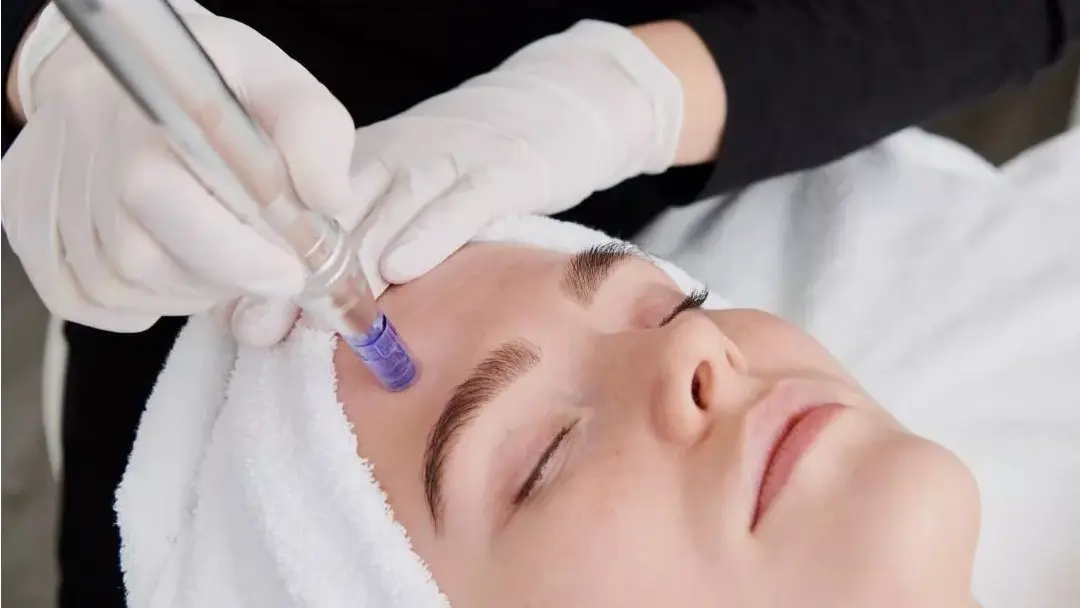 Kvinde med håndklæde om håret får mesoterapi med microneedling i panden
