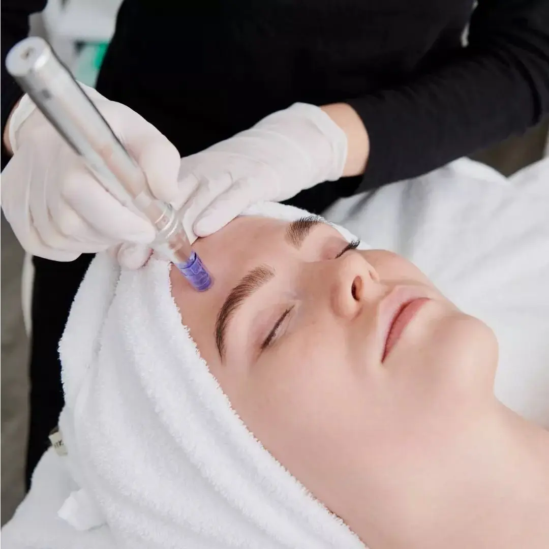Kvinde med håndklæde om håret får mesoterapi med microneedling i panden